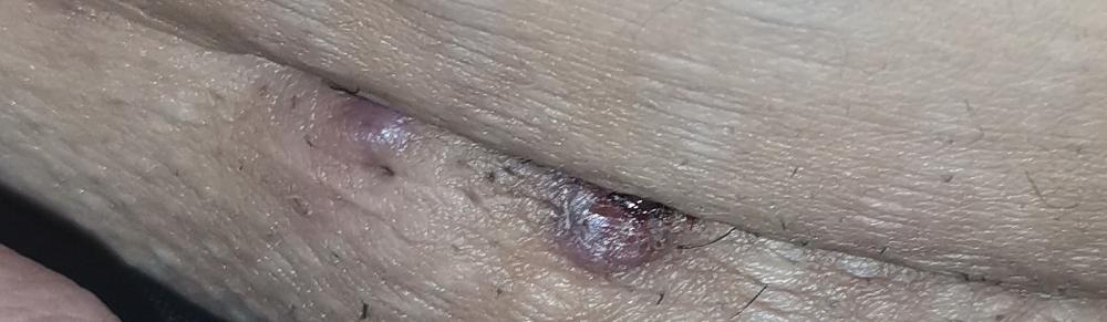 جای بخیه سزارین و جوش زدن جای بخیه