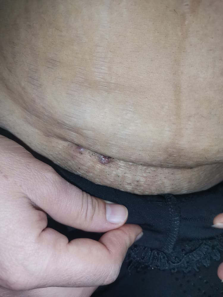 جای بخیه سزارین و جوش زدن جای بخیه