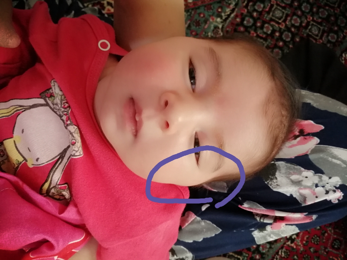 باد صورت نوزاد یک ماهه