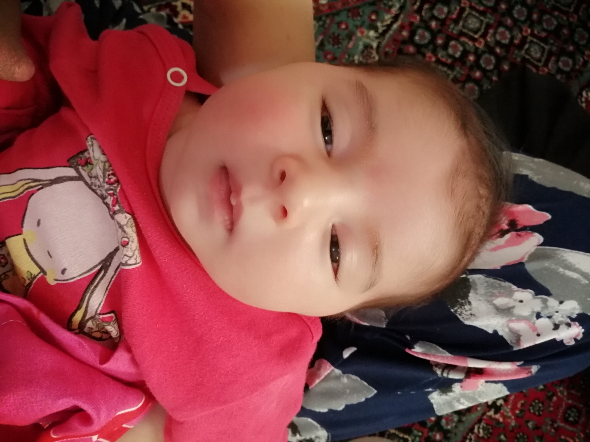 باد صورت نوزاد یک ماهه