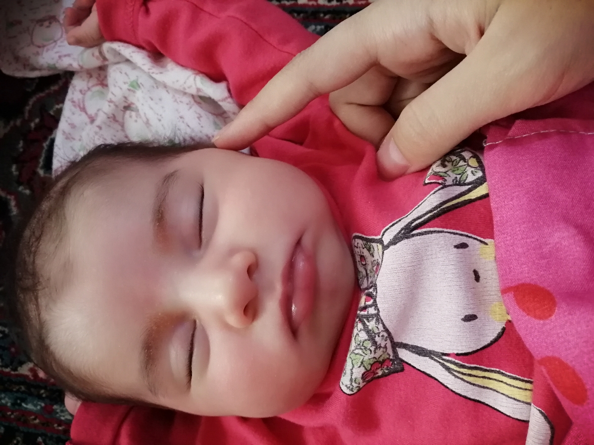 باد صورت نوزاد یک ماهه