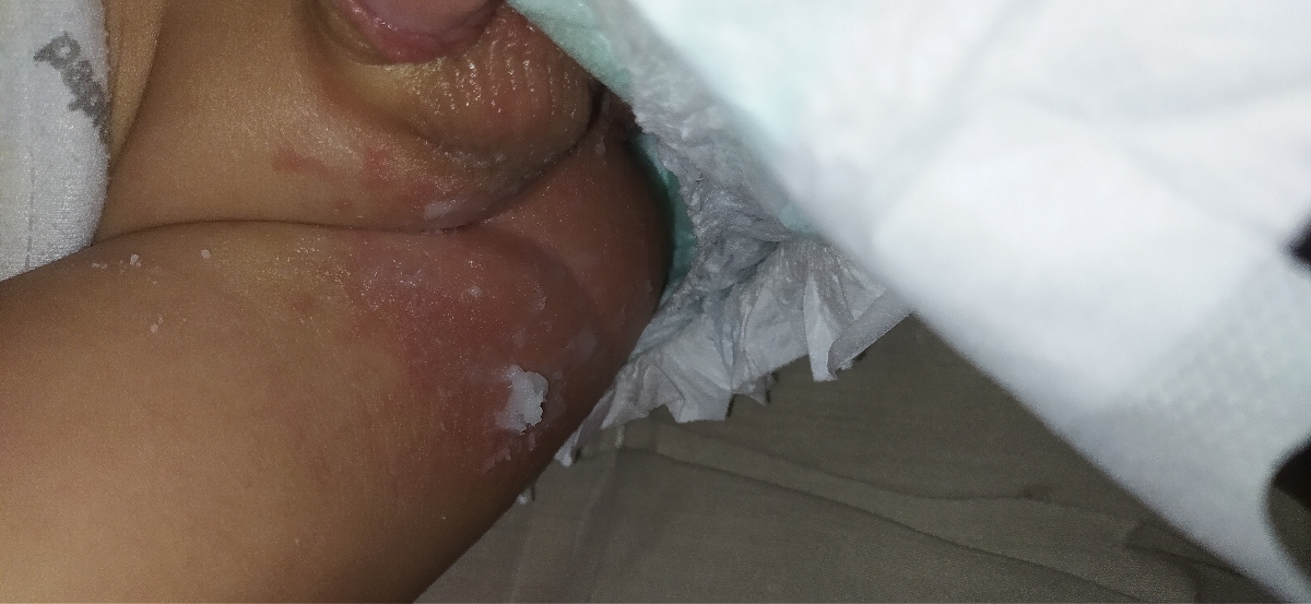 سوختگی وجوش ریز زده سوختی اثر پوشک
