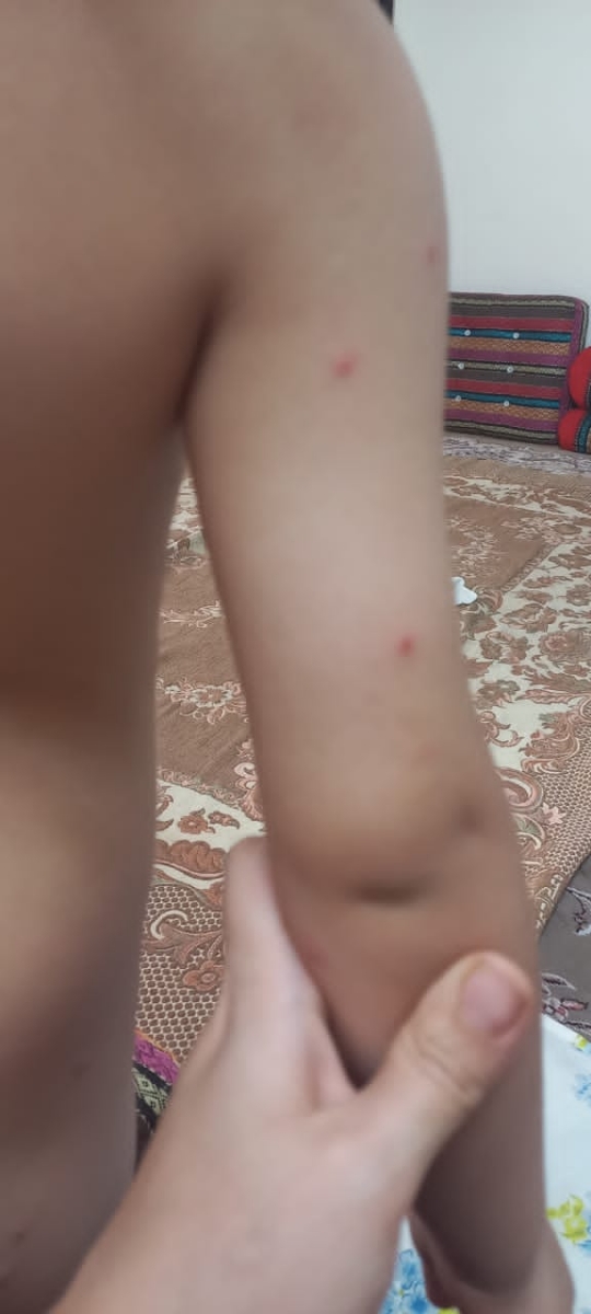 لکه های رو پوست جوش یا تاول مانند