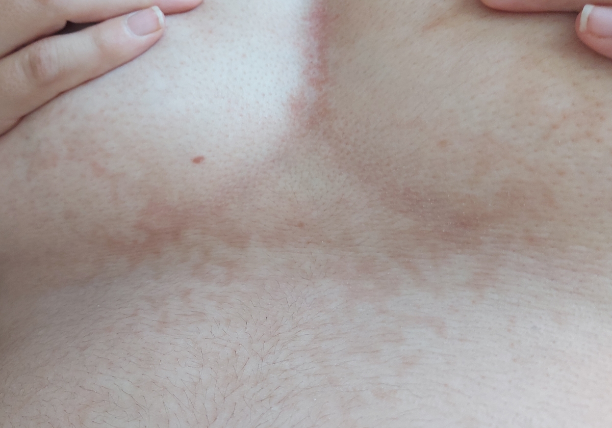 لک روی شکم ووسط سینه