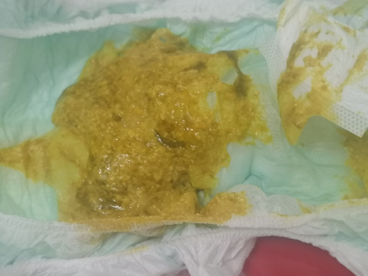 سلام وقت بخیر 😖عکس مدفوع پسرم رو میزارم😖 لطفا بگید طبیعی هست یا نه