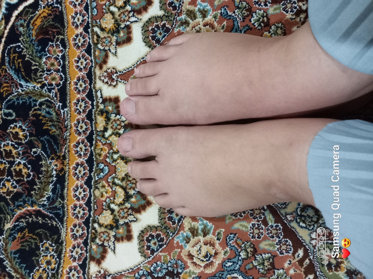 ورم روی پای راست درهفته۳۷بارداری