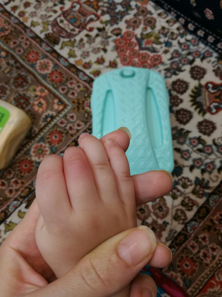 نیش زدگی و ورم دست دخترمممم