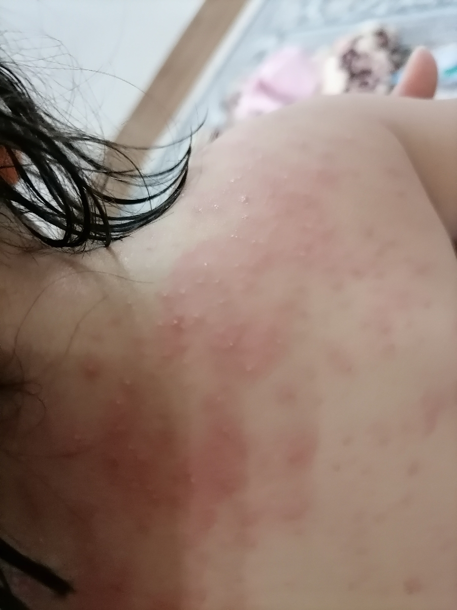دونه های دورگردن بچه یک ساله