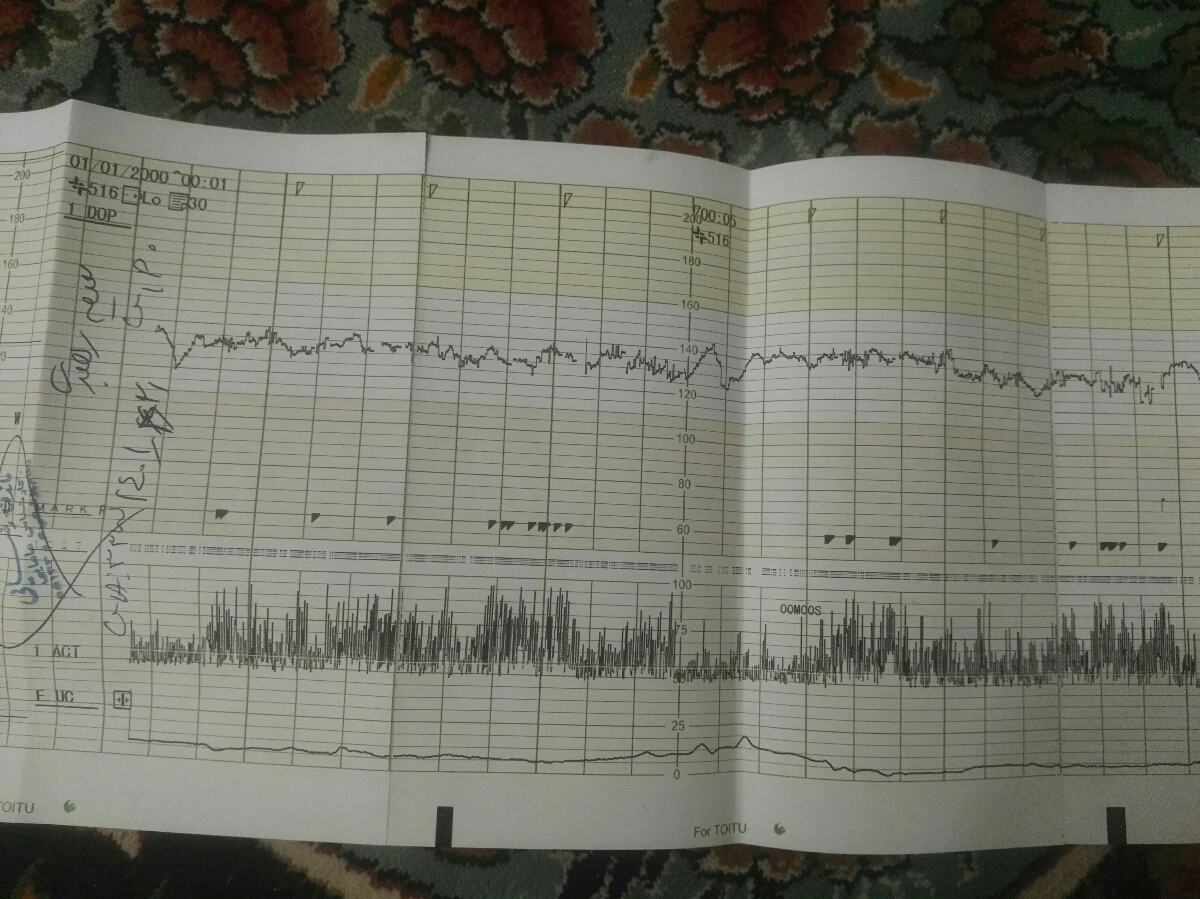 جواب نوار قلب بچه رو میشه بررسی کنید تشکر