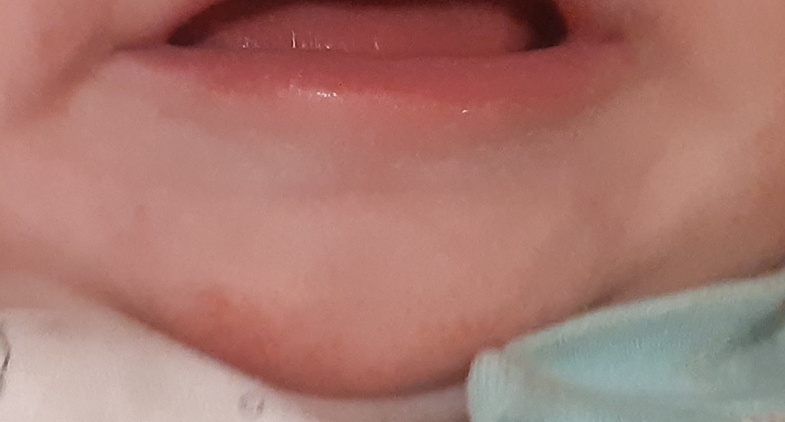 قرمزی چانه نوزاد ٨ ماه قرمزی چانه نوزاد ٨ ماه