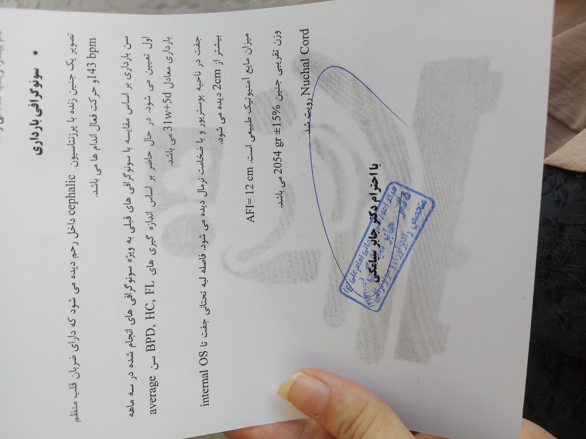 پیچیدن بند ناف دور بچه