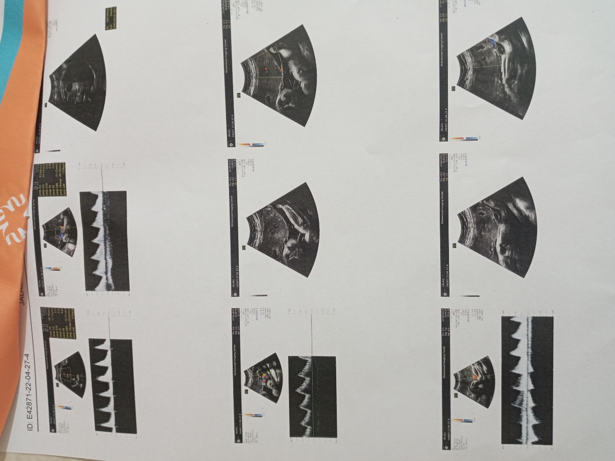 تفسیر سونو رنگی کالر داپلر تفسیر سونو رنگی کالر داپلر