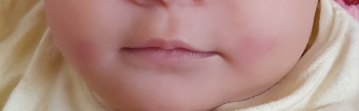 لکه ی حساسیت روی پوست نوزاد
