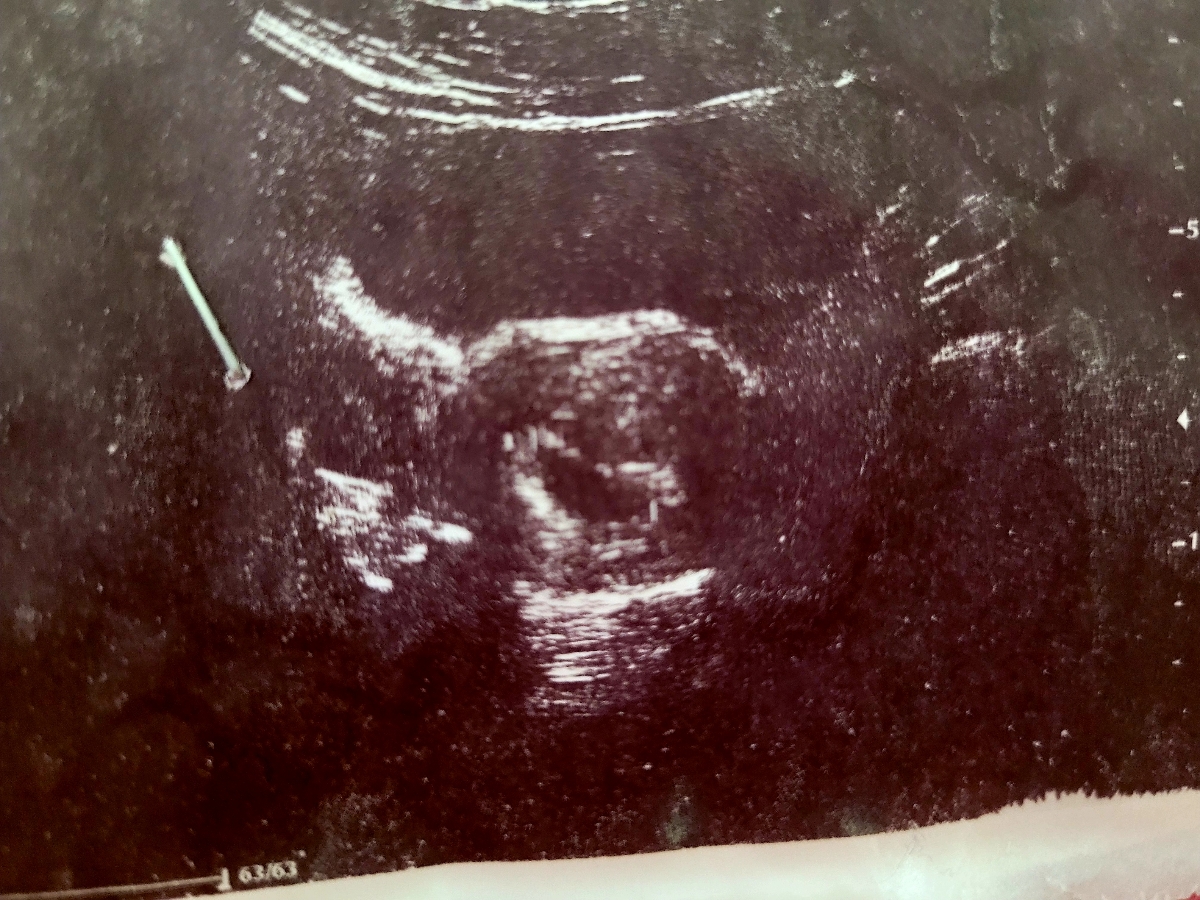 این عکس سونوگرافی هست دکتر