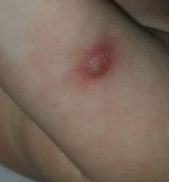 چرک کردن جای واکسن چرک کردن جای واکسن