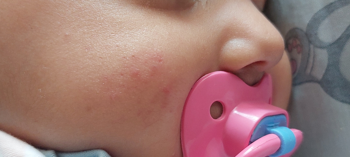 جوش زدن روی پوست صورت نوزاد ۵ ماهه+عکس جوش زدن روی پوست صورت نوزاد ۵ ماهه+عکس