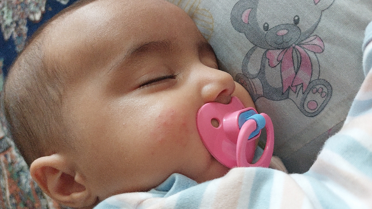 جوش زدن روی پوست صورت نوزاد ۵ ماهه+عکس جوش زدن روی پوست صورت نوزاد ۵ ماهه+عکس