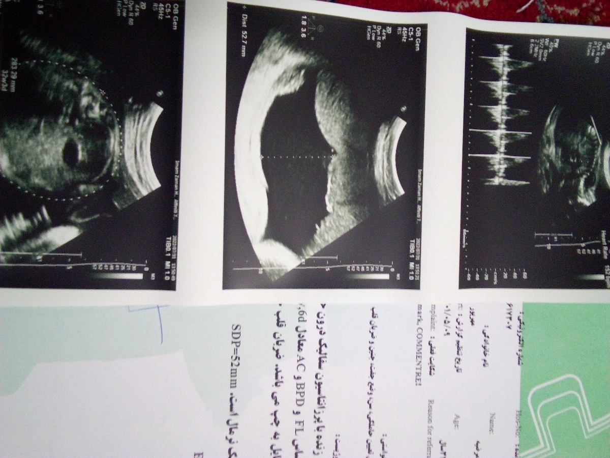 سونوگرافی سن، وضع جفت، جنين وضربان قلب