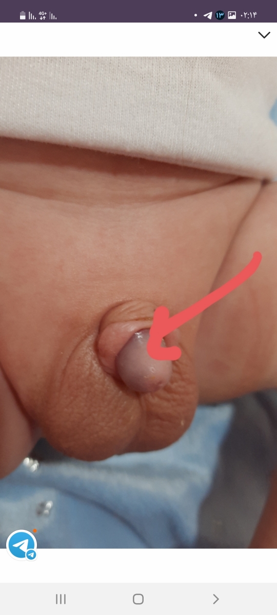 ورم آلت بچم😔😔😔 دوستان بیاین کمک توروخداااااا ورم آلت بچم😔😔😔 دوستان بیاین کمک توروخداااااا