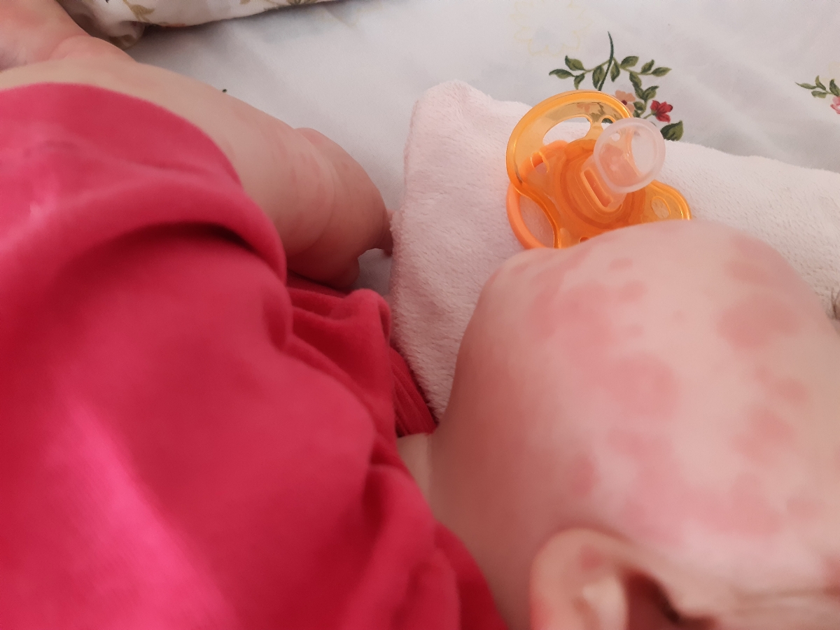 تمام بدنش مثل صورتش شده مادرم میگه سرخک تمام بدنش مثل صورتش شده مادرم میگه سرخک