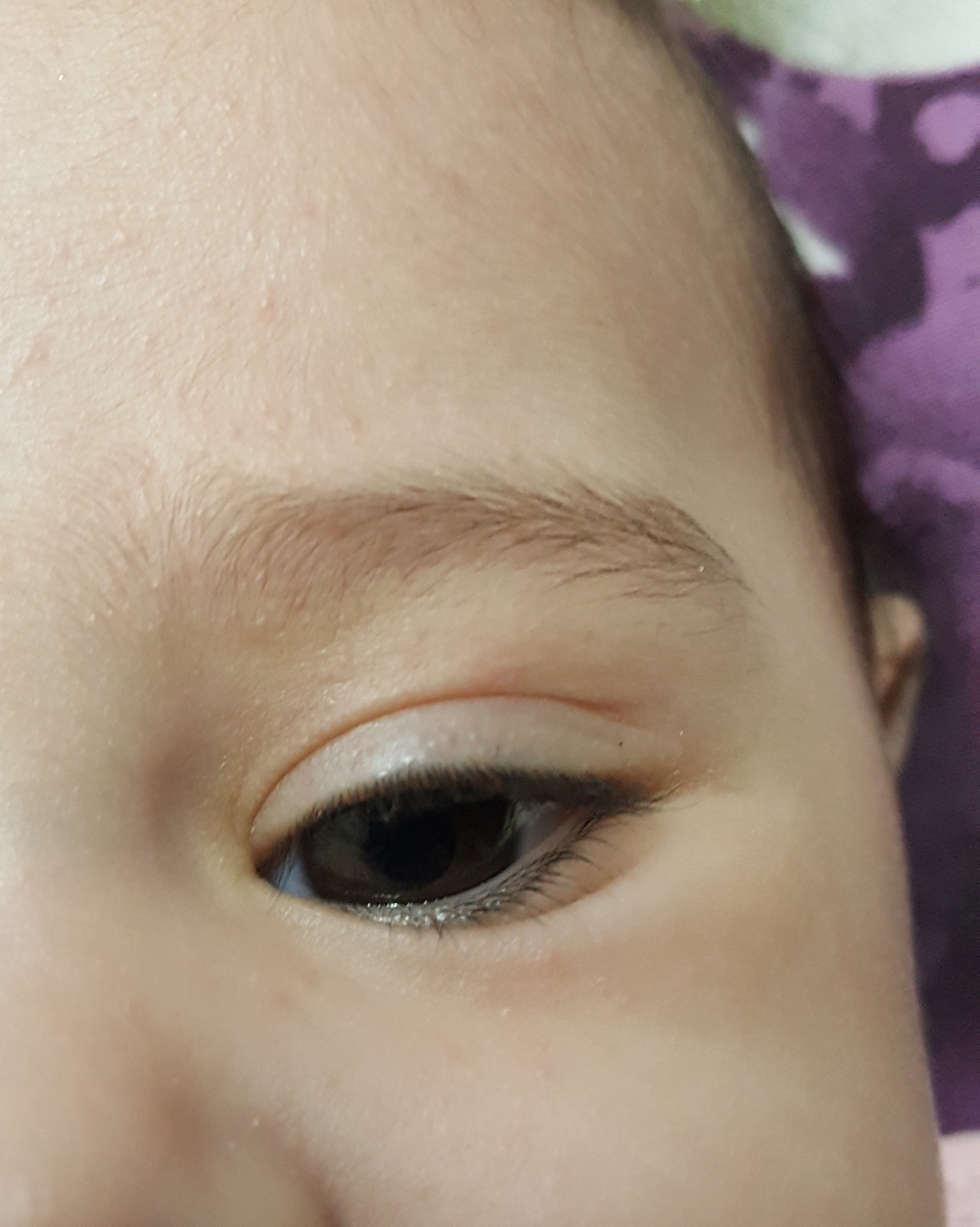 علت جوش های ریز روی پیشونی و زیر چشم علت جوش های ریز روی پیشونی و زیر چشم