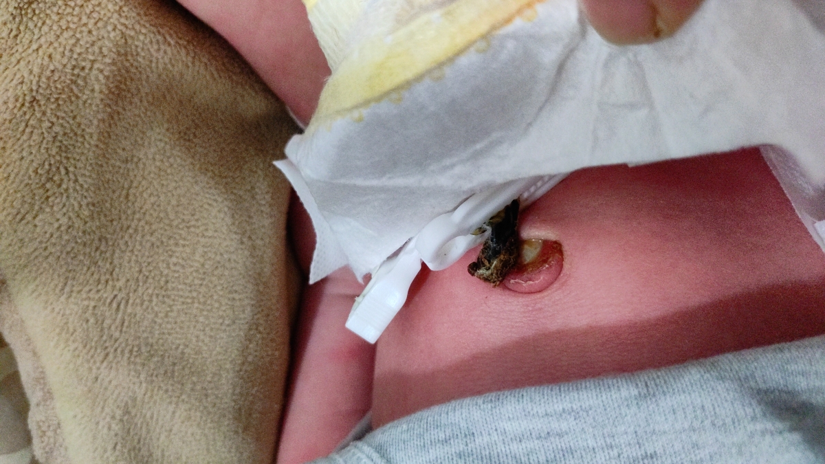 عفونت بند ناف نوزاد