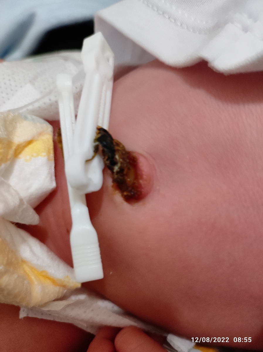 عفونت بند ناف نوزاد