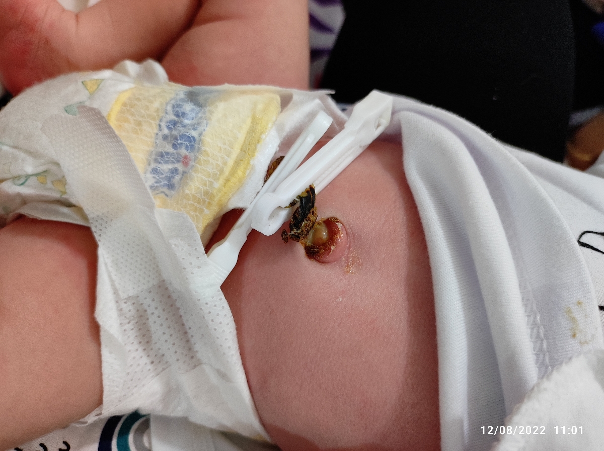 عفونت بند ناف نوزاد