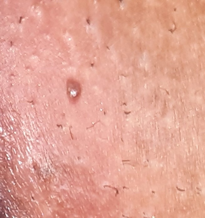 ایا این ضایعه زگیل تناسلیه؟