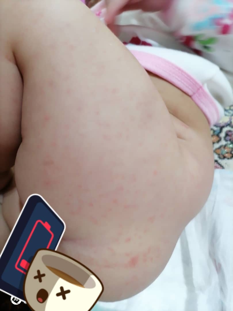 دونه های ریز و قرمز در پا نوزاد