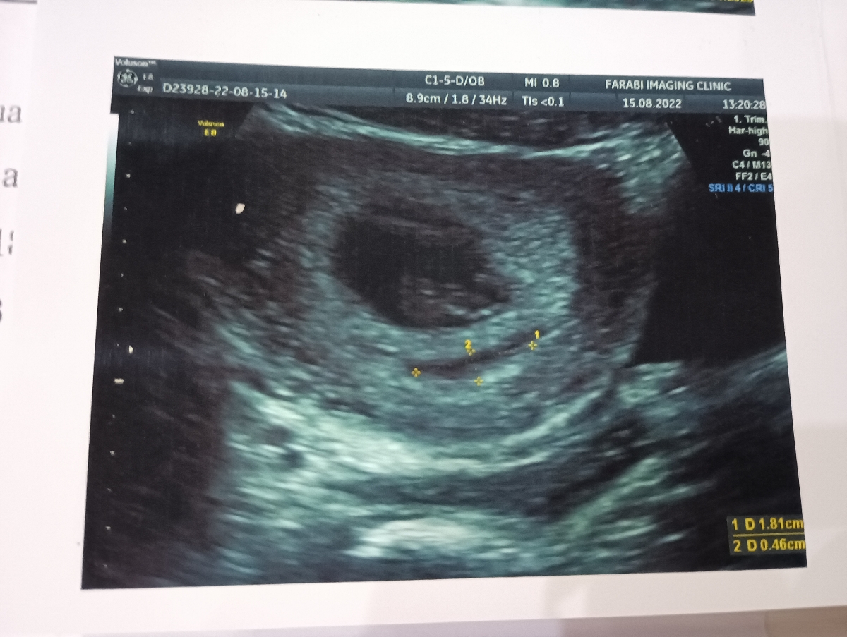 جواب سونو قلب هفته ۸ . داشتن هماتوم جواب سونو قلب هفته ۸ . داشتن هماتوم