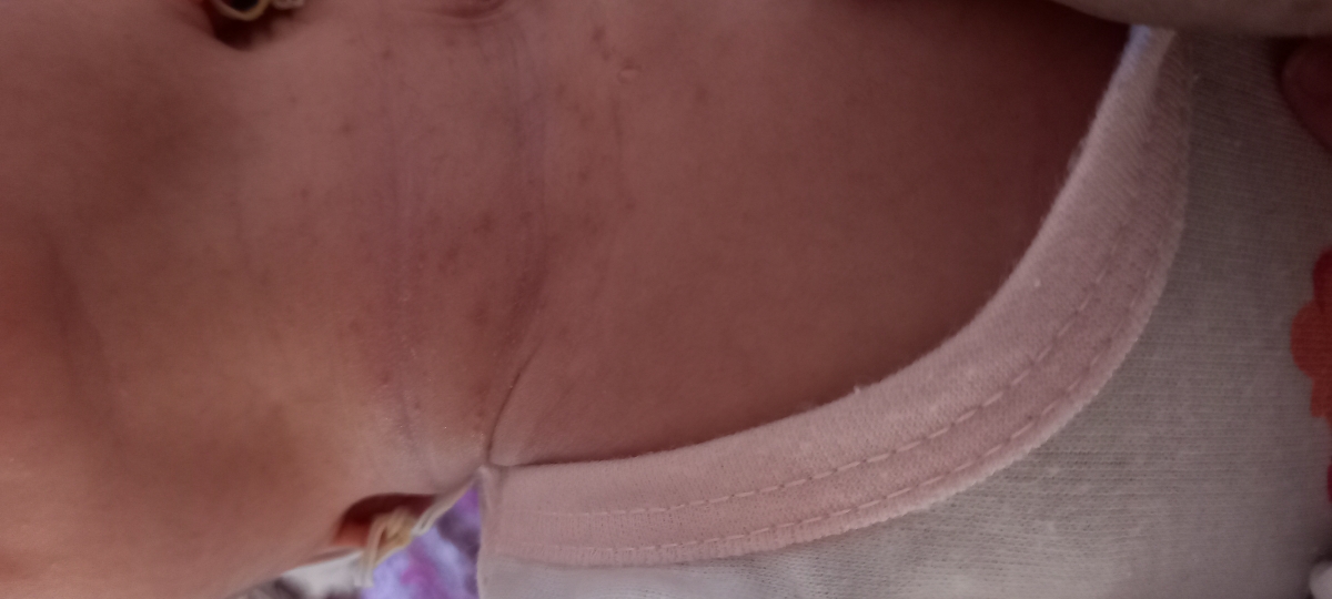 دونه های قرمز رو گلوی نوزاد