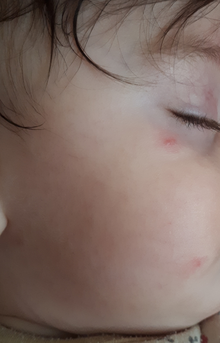 لکه و دونه های قرمز روی پوست