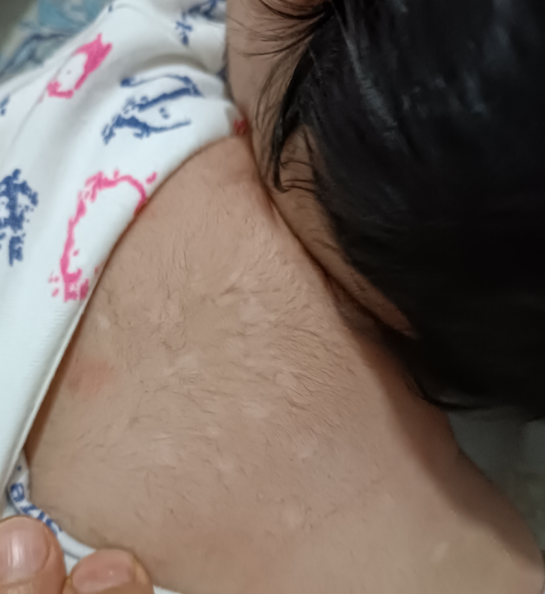 لکه های سفید روی پوست نوزاد لکه های سفید روی پوست نوزاد