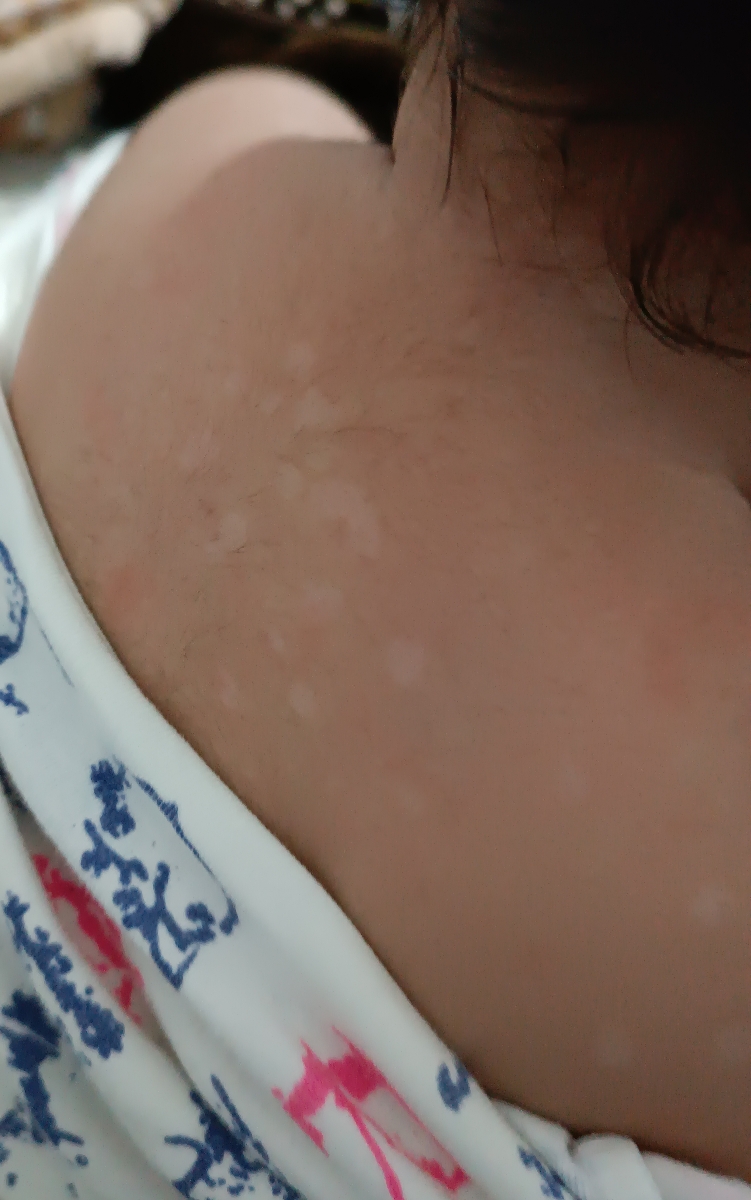 لکه های سفید روی پوست نوزاد لکه های سفید روی پوست نوزاد