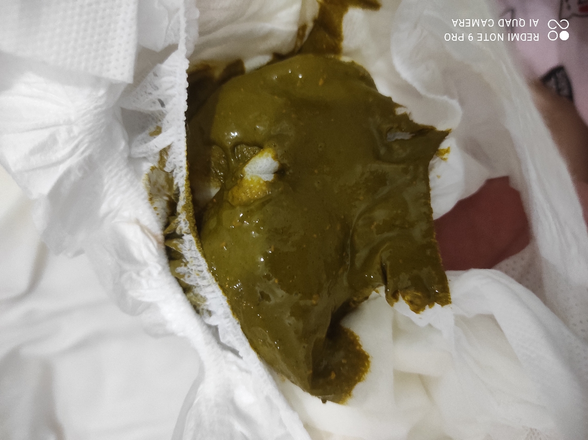 اولین مدفوع نوزاد بعد از واکسن دو ماهگی