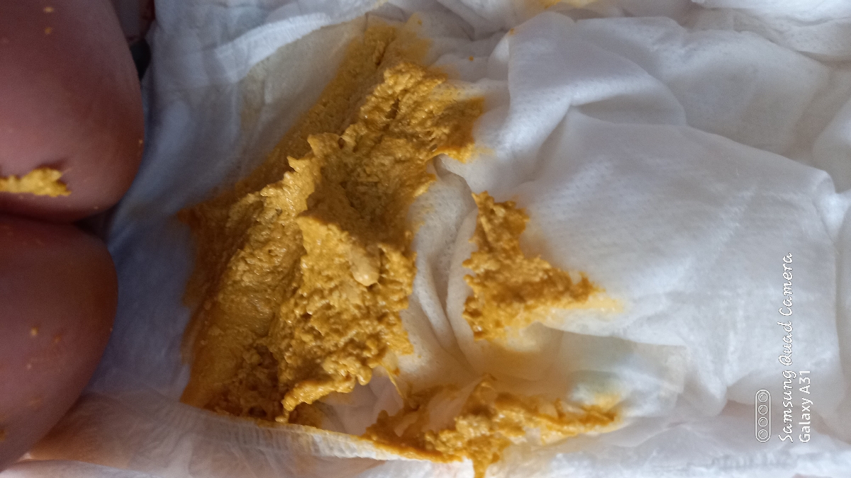 مدفوع غلیظ نوزاد دوماهه+عکس