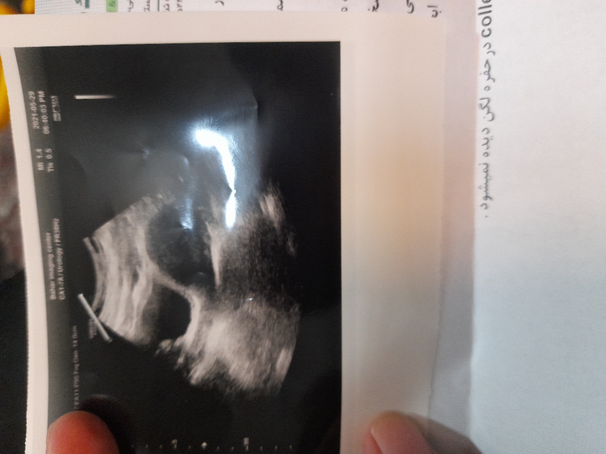 بی بی چک مثبت و سونوگرافی بدون علائم بارداری بی بی چک مثبت و سونوگرافی بدون علائم بارداری