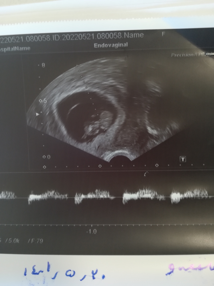 سونو وآزمایش NT کی باید انجام بشه سونو وآزمایش NT کی باید انجام بشه