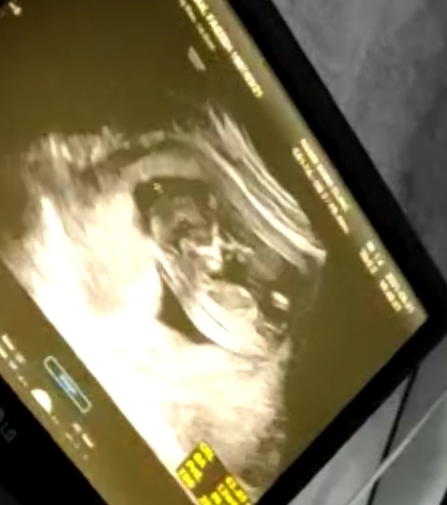 تشخیص جنسیت از سونوگرافی ۱۲ هفته