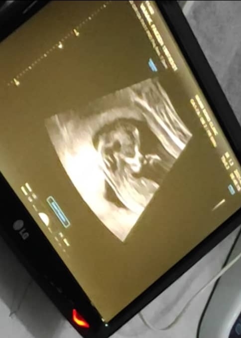 تشخیص جنسیت از سونوگرافی ۱۲ هفته