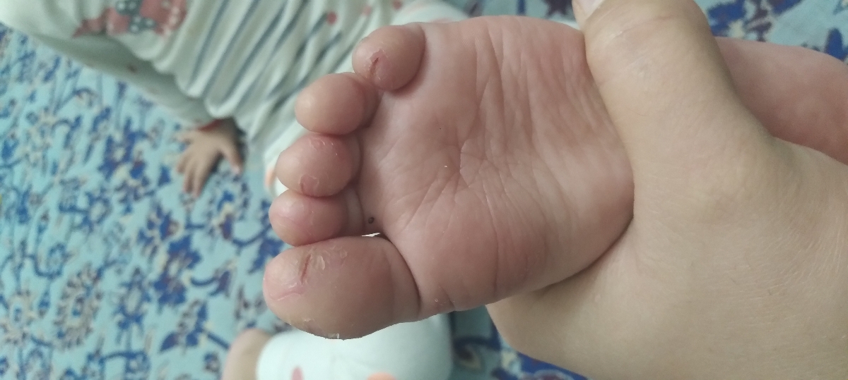 خانم دکتر پای دخترم پوست پوست و زخم شده خانم دکتر پای دخترم پوست پوست و زخم شده