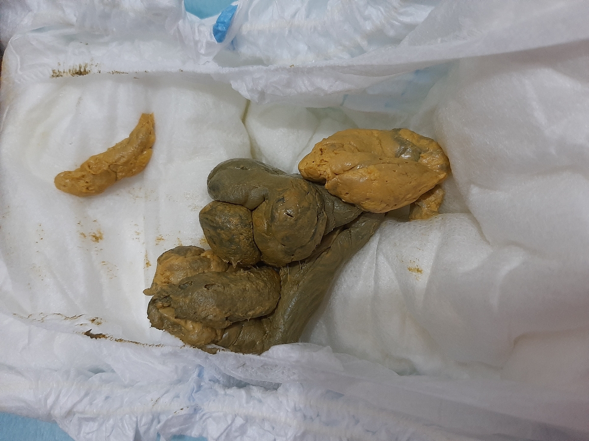 مدفوع سفت نوزادم همراه باعکس مدفوع سفت نوزادم همراه باعکس