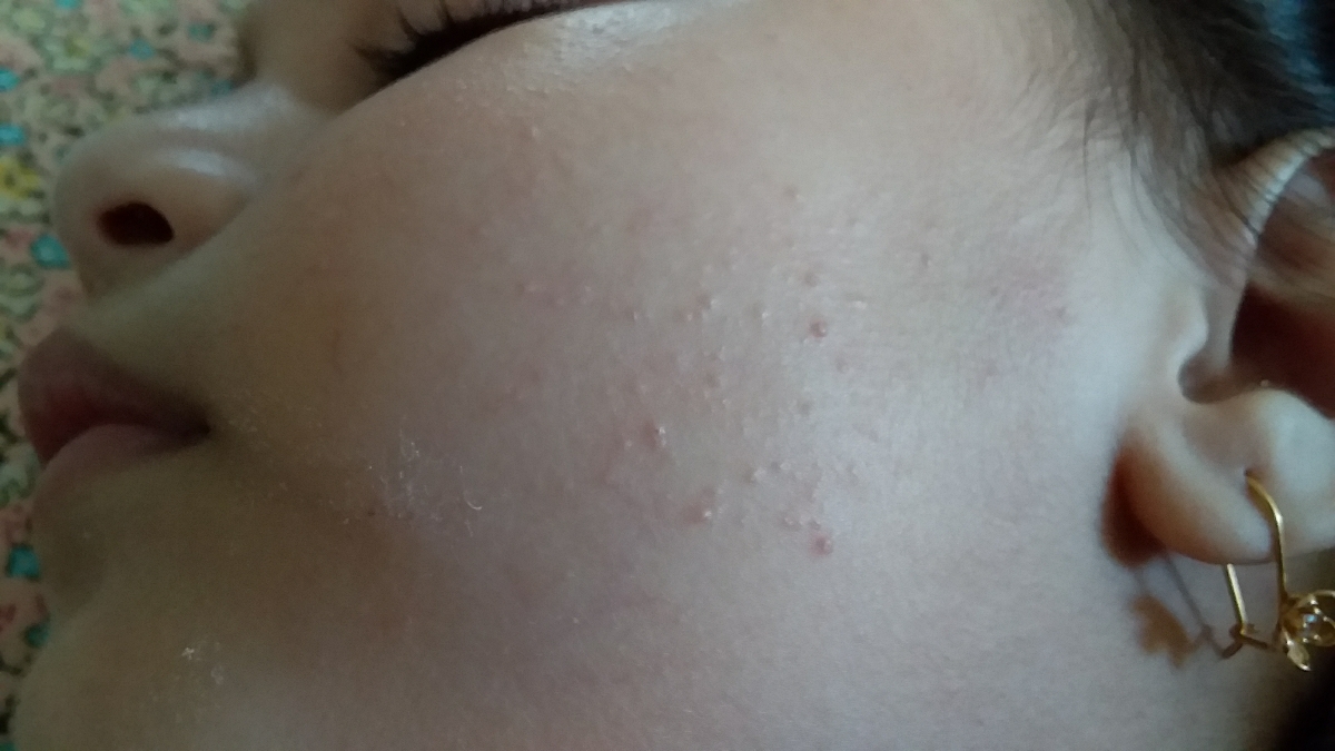 روی دوتا لپای دختزم از این جوشای سفت زده