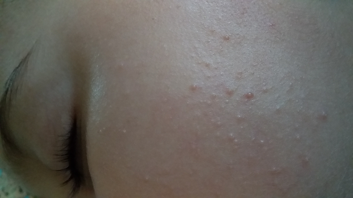 روی دوتا لپای دختزم از این جوشای سفت زده