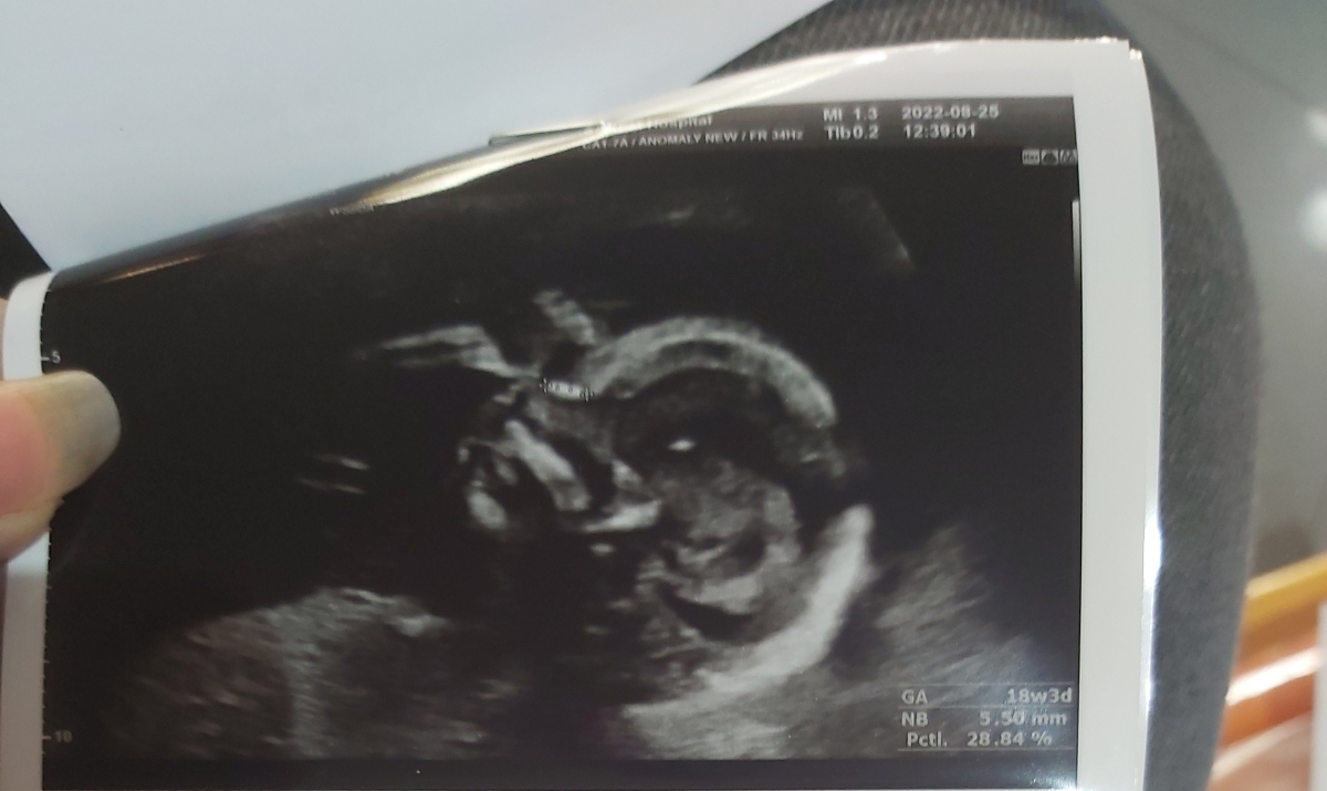 تفسیر سونو آنومالی تفسیر سونو آنومالی