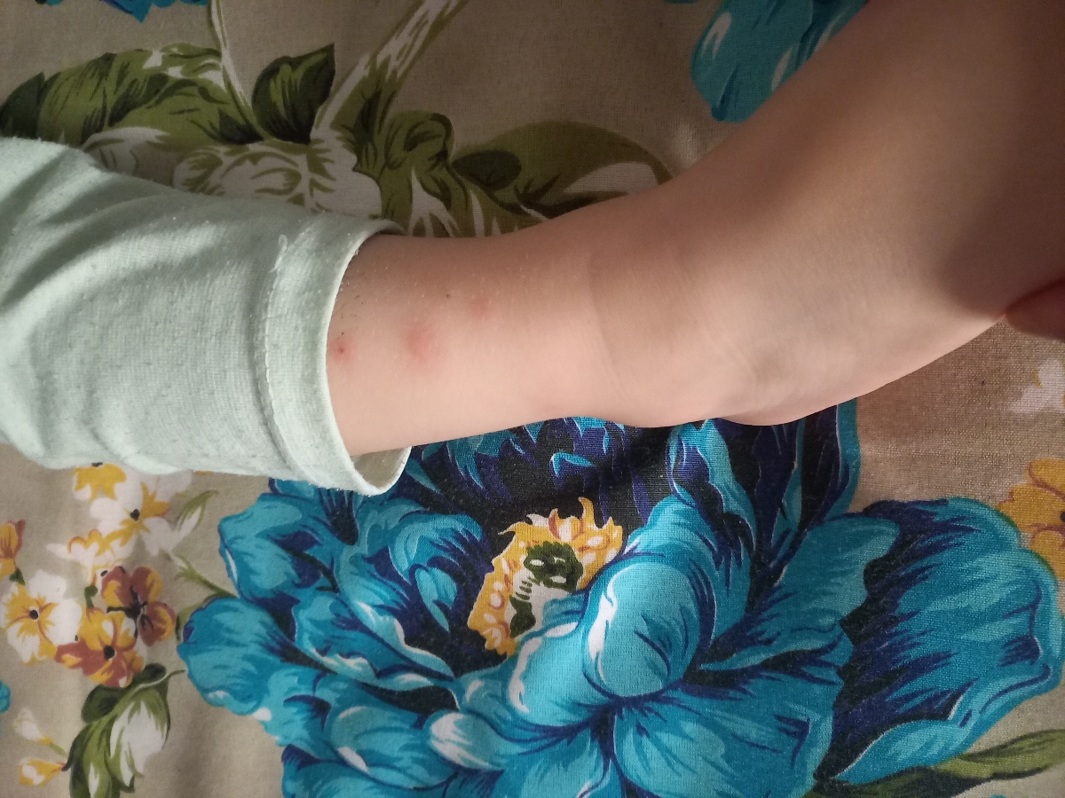 دخترم بدنش خیلی دونه زده نمیدونم چرا ؟ دخترم بدنش خیلی دونه زده نمیدونم چرا ؟