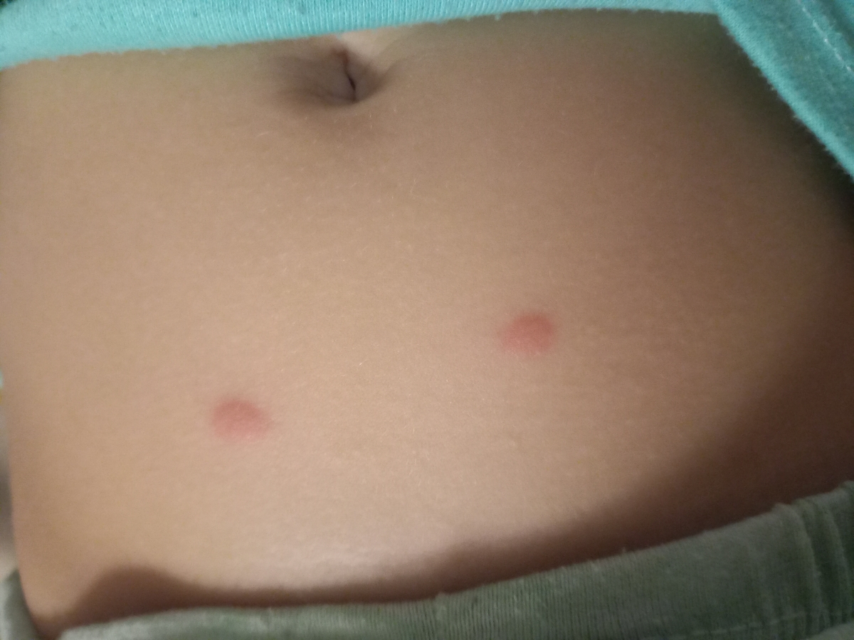 دخترم بدنش خیلی دونه زده نمیدونم چرا ؟ دخترم بدنش خیلی دونه زده نمیدونم چرا ؟