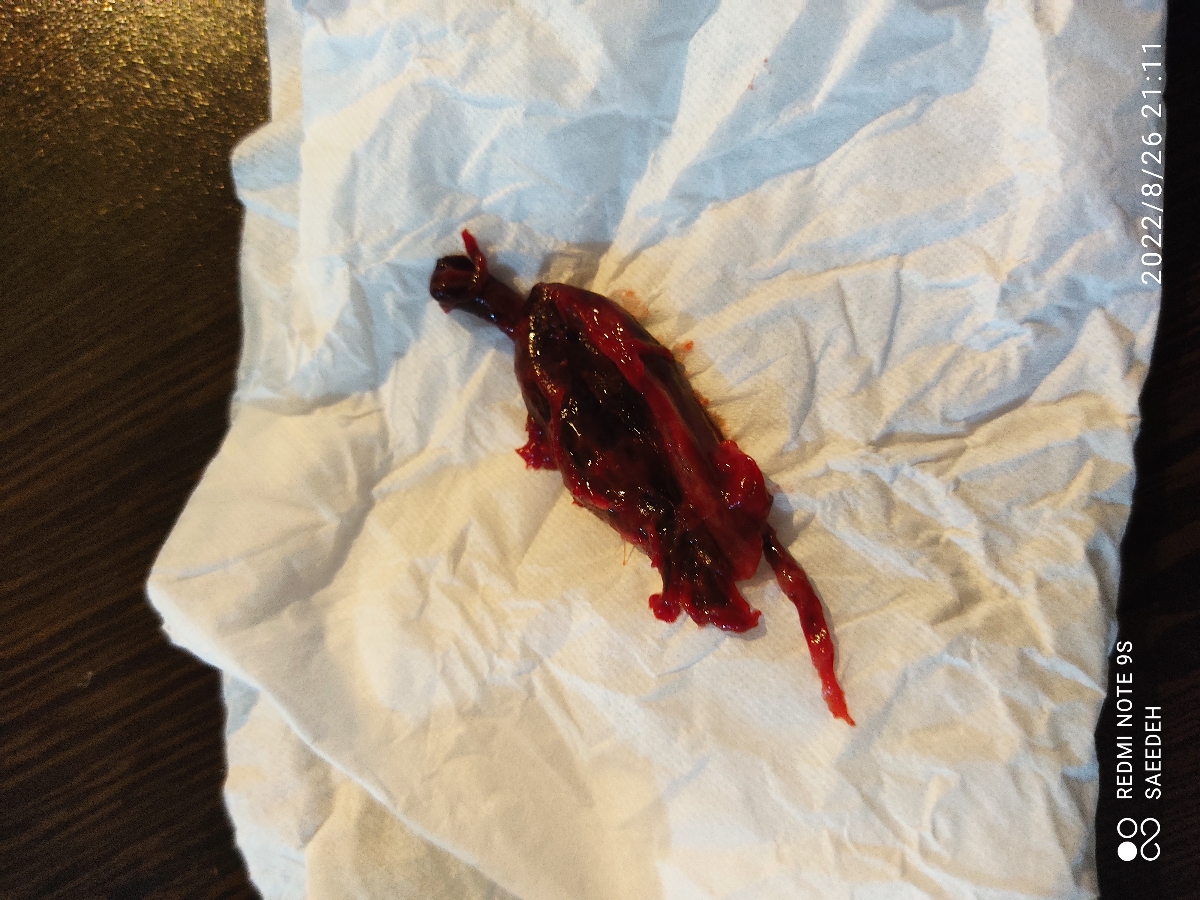 بارداری پوچ وساک حاملگی بارداری پوچ وساک حاملگی