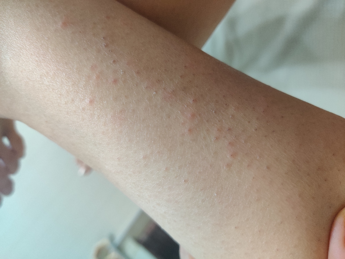 عامل خارش ساق پا